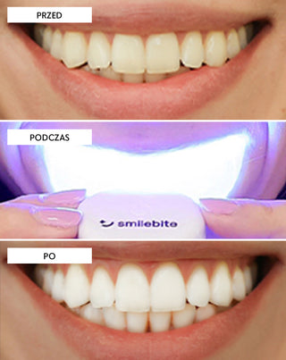 Sada na bělení zubů s LED lampou a bělícím gelem Light & Bright Smilebite - 6