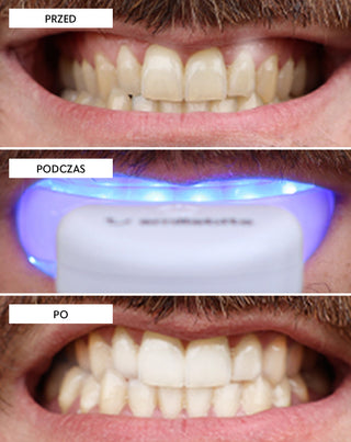 Sada na bělení zubů s LED lampou a bělícím gelem Light &amp;amp; Bright Smilebite