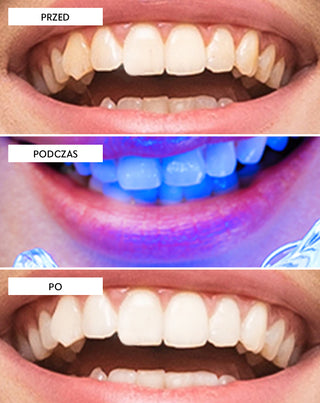 Sada na bělení zubů s LED lampou a bělícím gelem Light &amp;amp; Bright Smilebite